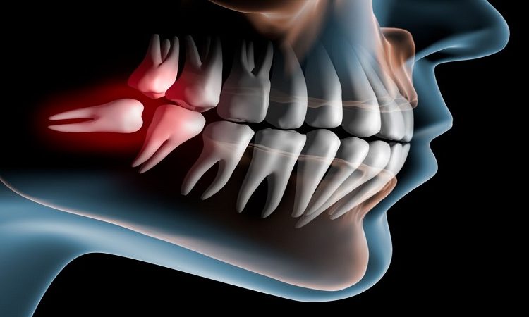 علائم دندان نیمه نهفته | Le meilleur dentiste d'Ispahan - le meilleur chirurgien des gencives d'Ispahan - le meilleur dentiste cosmétique d'Ispahan