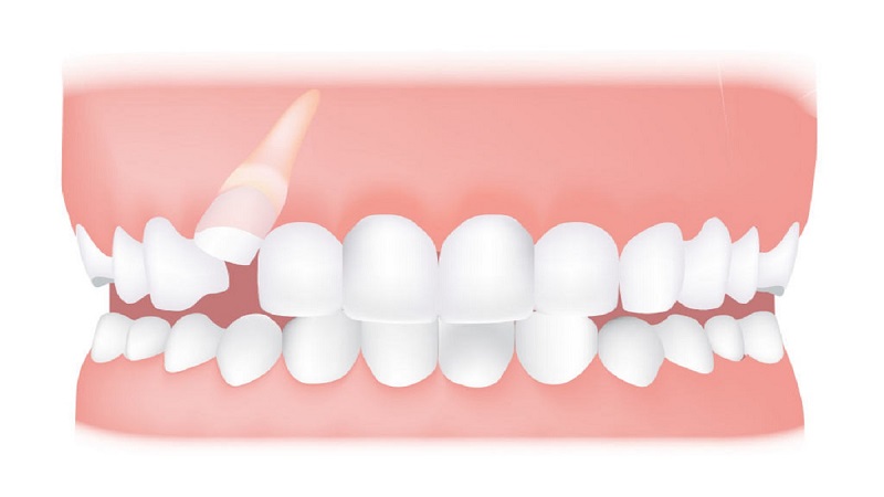 دلایل نهفته شدن دندان در زیر لثه | Le meilleur dentiste d'Ispahan - le meilleur chirurgien des gencives d'Ispahan - le meilleur dentiste cosmétique d'Ispahan