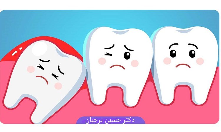 مشکلات دندان عقل | بهترین دندانپزشک اصفهان-بهترین جراح لثه اصفهان-بهترین دندانپزشک زیبایی اصفهان