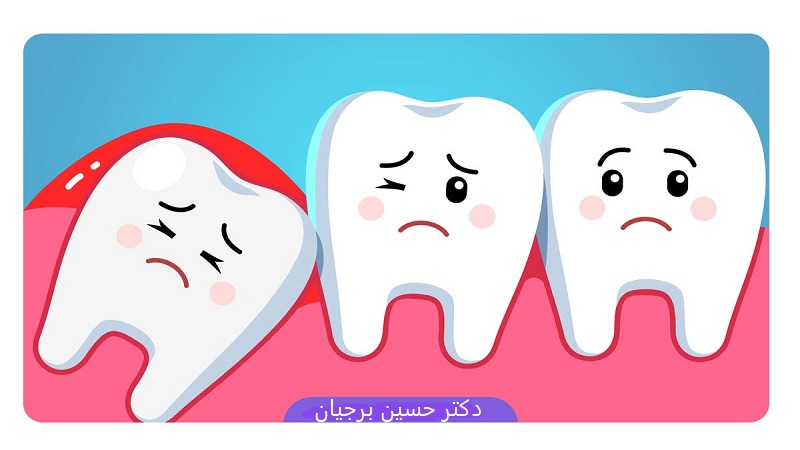 مشکلات دندان عقل | بهترین دندانپزشک اصفهان-بهترین جراح لثه اصفهان-بهترین دندانپزشک زیبایی اصفهان