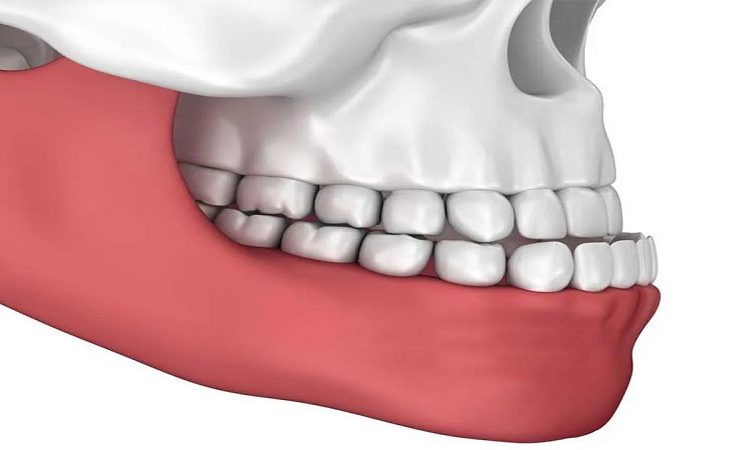 Quels sont les moyens de traiter les sous-occlusions légères et modérées ? | Le meilleur dentiste d'Ispahan - le meilleur chirurgien des gencives d'Ispahan - le meilleur dentiste cosmétique d'Ispahan