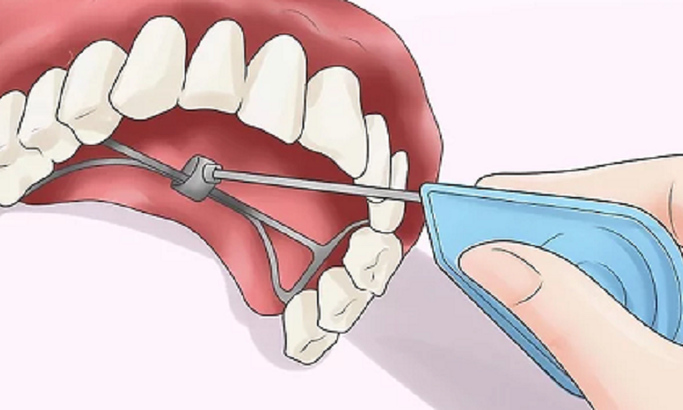 کاربرد وسیع کننده کام یا پالاتال اکسپندر | Le meilleur dentiste d'Ispahan - le meilleur chirurgien des gencives d'Ispahan - le meilleur dentiste cosmétique d'Ispahan