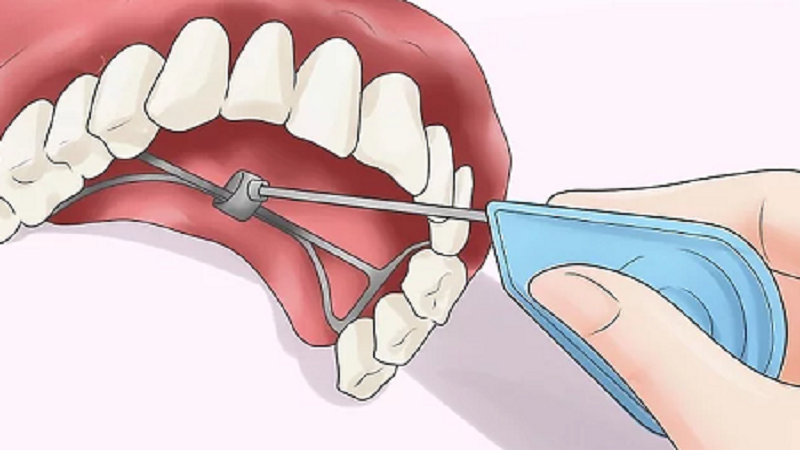 کاربرد وسیع کننده کام یا پالاتال اکسپندر | Le meilleur dentiste d'Ispahan - le meilleur chirurgien des gencives d'Ispahan - le meilleur dentiste cosmétique d'Ispahan