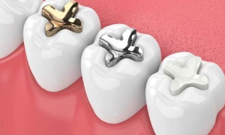 گلاس آینومر چیست؟ | The best dentist in Isfahan - the best gum surgeon in Isfahan - the best cosmetic dentist in Isfahan