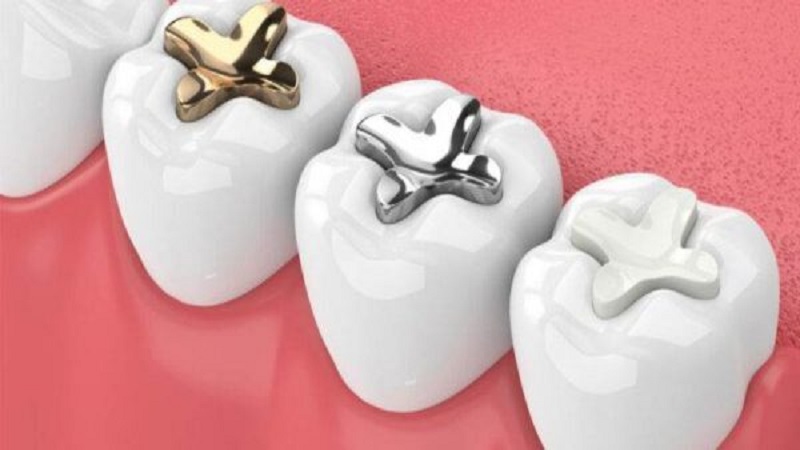 گلاس آینومر چیست؟ | The best dentist in Isfahan - the best gum surgeon in Isfahan - the best cosmetic dentist in Isfahan