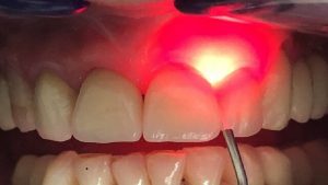 کاربرد لیزر تراپی دندان (قسمت دوم) | بهترین دندانپزشک اصفهان-بهترین جراح لثه اصفهان-بهترین دندانپزشک زیبایی اصفهان