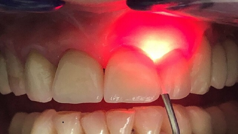 کاربرد لیزر تراپی دندان(قسمت اول) | أفضل طبيب أسنان في أصفهان - أفضل جراح لثة في أصفهان - أفضل طبيب أسنان تجميلي في أصفهان