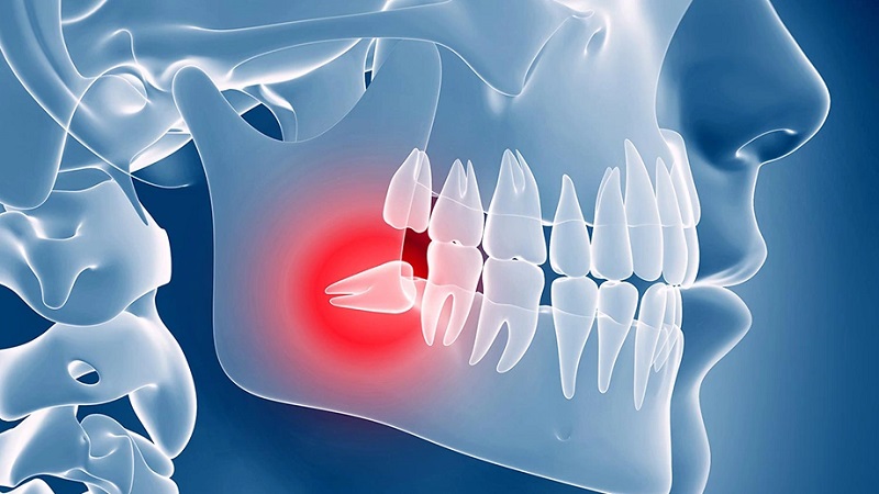 What is the treatment of impacted teeth? | The best dentist in Isfahan - the best gum surgeon in Isfahan - the best cosmetic dentist in Isfahan