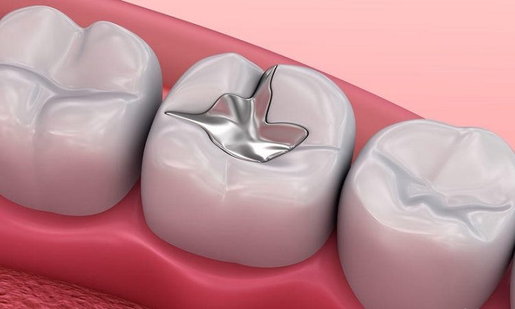 آمالگام چیست؟ | بهترین دندانپزشک اصفهان-بهترین جراح لثه اصفهان-بهترین دندانپزشک زیبایی اصفهان