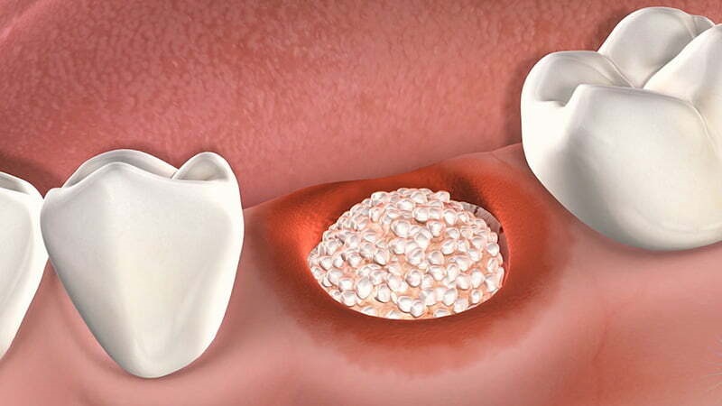 چه کسانی به پیوند استخوان راموس نیاز دارند؟ | بهترین دندانپزشک اصفهان - بهترین جراح لثه اصفهان - بهترین دندانپزشک زیبایی اصفهان