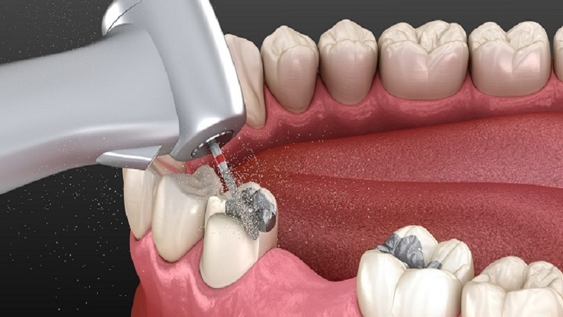 Quels matériaux peuvent être utilisés pour remplacer l’amalgame ? | Le meilleur dentiste d'Ispahan - le meilleur chirurgien des gencives d'Ispahan - le meilleur dentiste cosmétique d'Ispahan