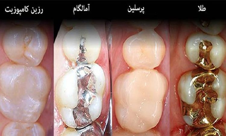 از چه موادی می‌توان برای جایگزین آمالگام استفاده کرد؟ | The best dentist in Isfahan - the best gum surgeon in Isfahan - the best cosmetic dentist in Isfahan