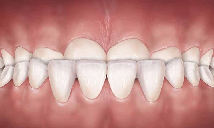 علائم آندربایت چیست؟ | The best dentist in Isfahan - the best gum surgeon in Isfahan - the best cosmetic dentist in Isfahan