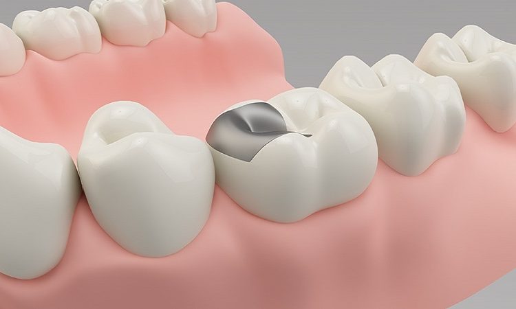 Avantages de l'amalgame pour les dents | Le meilleur dentiste d'Ispahan - le meilleur chirurgien des gencives d'Ispahan - le meilleur dentiste cosmétique d'Ispahan