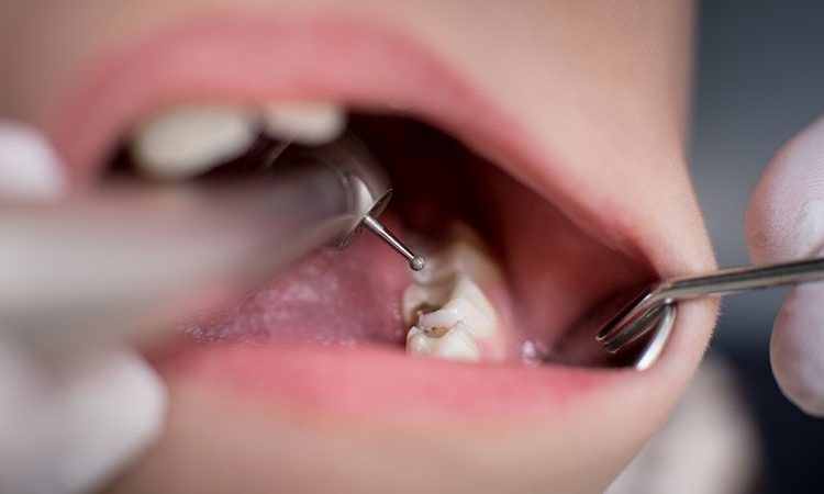 راه حل موقت محافظت از دندان پرشده | Le meilleur dentiste d'Ispahan - le meilleur chirurgien des gencives d'Ispahan - le meilleur dentiste cosmétique d'Ispahan