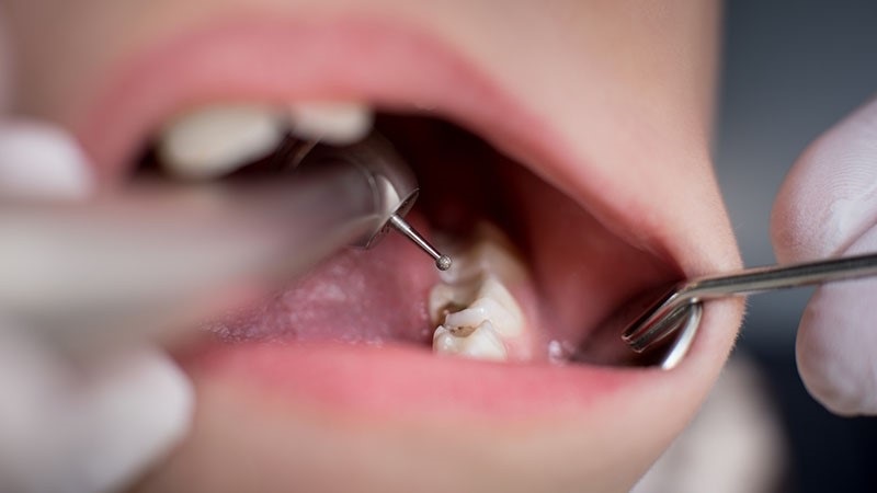 راه حل موقت محافظت از دندان پرشده | Le meilleur dentiste d'Ispahan - le meilleur chirurgien des gencives d'Ispahan - le meilleur dentiste cosmétique d'Ispahan