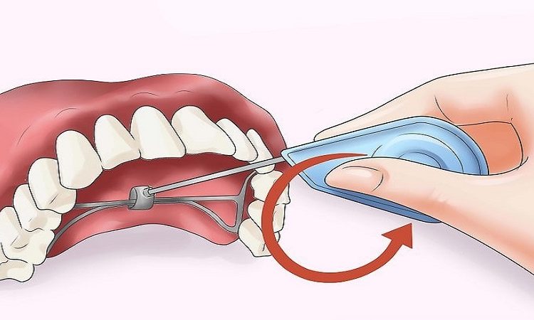 كيفية تركيب وصيانة جهاز تكبير الفك | أفضل طبيب أسنان في أصفهان - أفضل جراح لثة في أصفهان - أفضل طبيب أسنان تجميلي في أصفهان