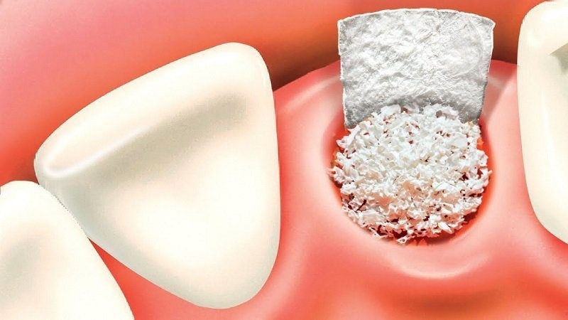 How to reduce pain caused by jawbone transplant? | The best dentist in Isfahan - The best gum surgeon in Isfahan - The best cosmetic dentist in Isfahan