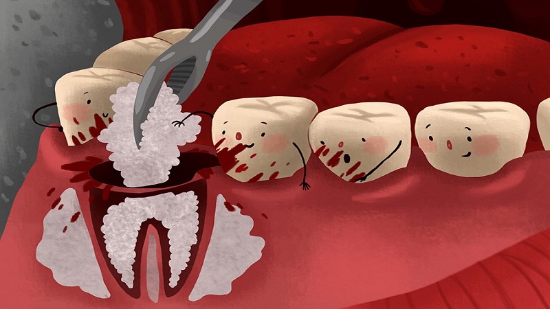 مراحل پیوند استخوان چگونه است؟ | بهترین دندانپزشک اصفهان - بهترین جراح لثه اصفهان - بهترین دندانپزشک زیبایی اصفهان