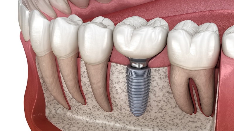 Remplacer les dents manquantes | Le meilleur dentiste d'Ispahan - le meilleur chirurgien des gencives d'Ispahan - le meilleur dentiste cosmétique d'Ispahan | Dr Hossein Borjian