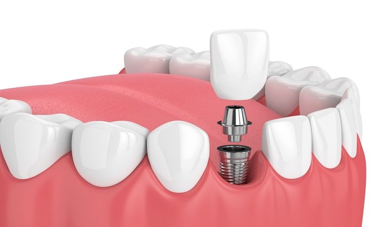 Dental implant | The best dentist in Isfahan - the best gum surgeon in Isfahan - the best cosmetic dentist in Isfahan | Dr. Hossein Borjian