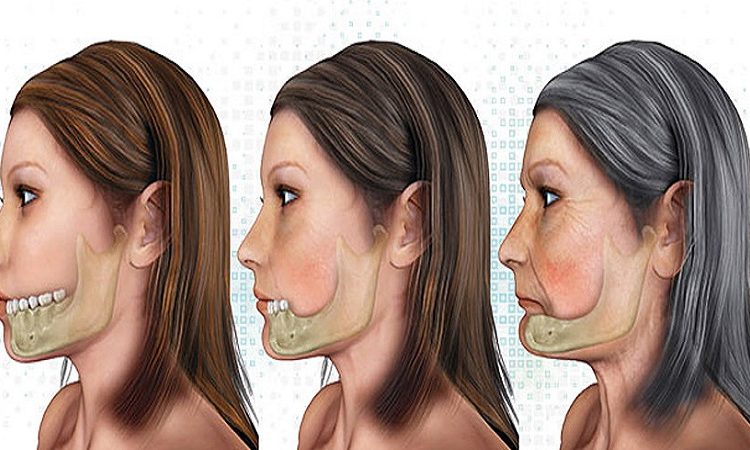 What are the complications of jaw bone loss? | The best dentist in Isfahan - The best gum surgeon in Isfahan - The best cosmetic dentist in Isfahan
