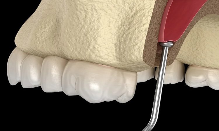 لیفت سینوس چیست؟ | بهترین دندانپزشک اصفهان - بهترین جراح لثه اصفهان - بهترین دندانپزشک زیبایی اصفهان