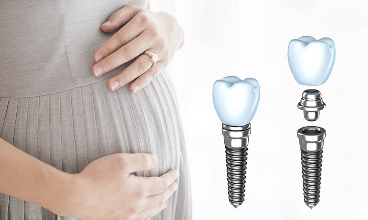 Quels sont les risques liés à l’implantation d’un implant dentaire pendant la grossesse ? | Le meilleur dentiste d'Ispahan - Le meilleur chirurgien des gencives à Ispahan - Le meilleur dentiste cosmétique à Ispahan