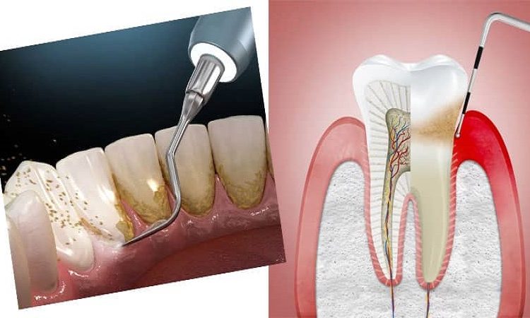 The difference between gum scaling and tooth scaling | The best dentist in Isfahan - the best gum surgeon in Isfahan - the best cosmetic dentist in Isfahan | Dr. Hossein Borjian