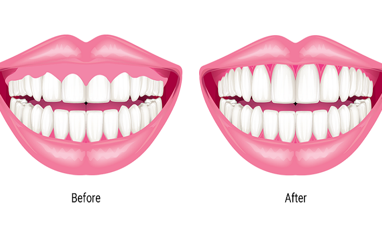 Gum lift | The best dentist in Isfahan - the best gum surgeon in Isfahan - the best cosmetic dentist in Isfahan | Dr. Hossein Borjian