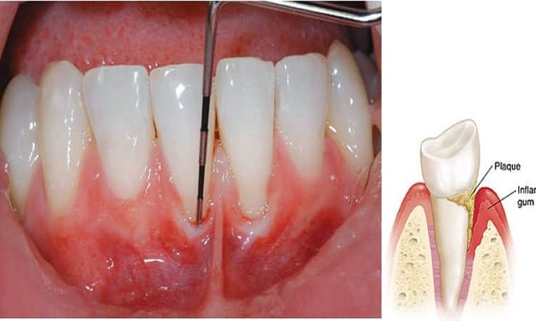 Complications of gum scaling | The best dentist in Isfahan - the best gum surgeon in Isfahan - the best cosmetic dentist in Isfahan | Dr. Hossein Borjian