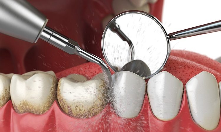 جرم گیری دندان لمینت شده | Le meilleur dentiste d'Ispahan - le meilleur chirurgien des gencives d'Ispahan - le meilleur dentiste cosmétique d'Ispahan | Dr Hossein Borjian