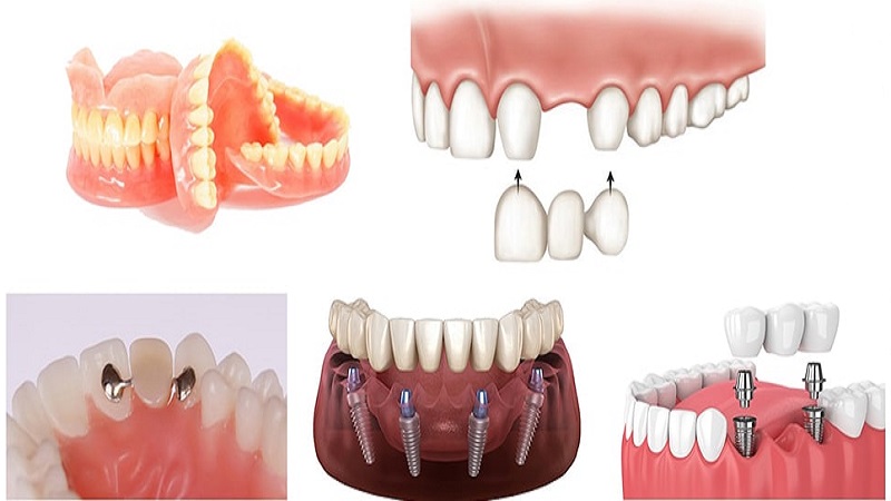 Remplacer les dents manquantes | Le meilleur dentiste d'Ispahan - le meilleur chirurgien des gencives d'Ispahan - le meilleur dentiste cosmétique d'Ispahan | Dr Hossein Borjian