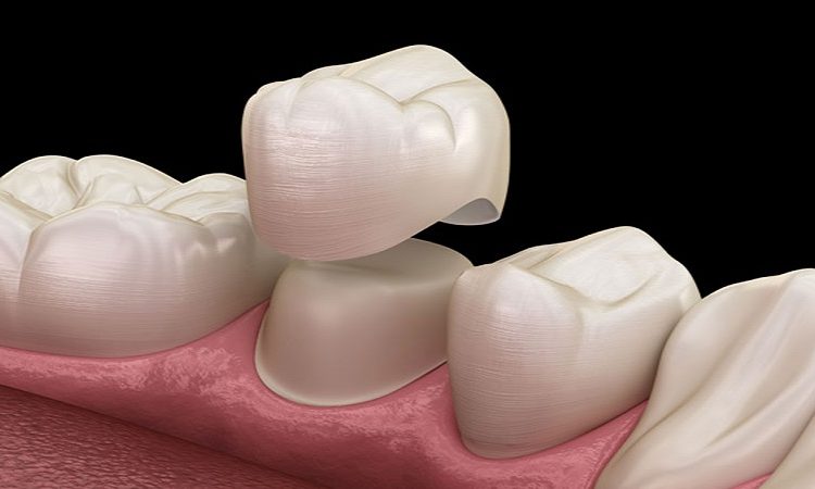 Types of dental prostheses | The best dentist in Isfahan - the best gum surgeon in Isfahan - the best cosmetic dentist in Isfahan | Dr. Hossein Borjian
