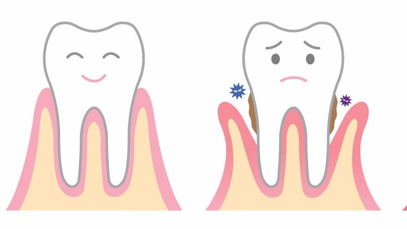 Diagnosis and treatment of gum diseases | The best dentist in Isfahan - the best gum surgeon in Isfahan - the best cosmetic dentist in Isfahan | Dr. Hossein Borjian