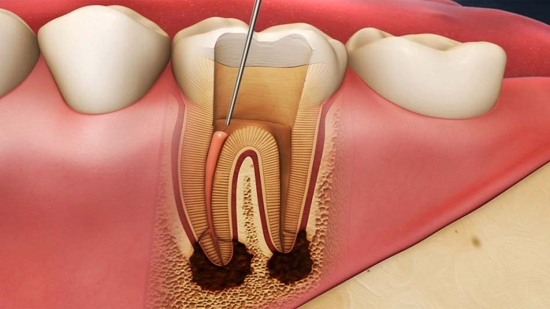 درد دندان به عصب رسیده | Le meilleur dentiste d'Ispahan - le meilleur chirurgien des gencives d'Ispahan - le meilleur dentiste cosmétique d'Ispahan | Dr Hossein Borjian