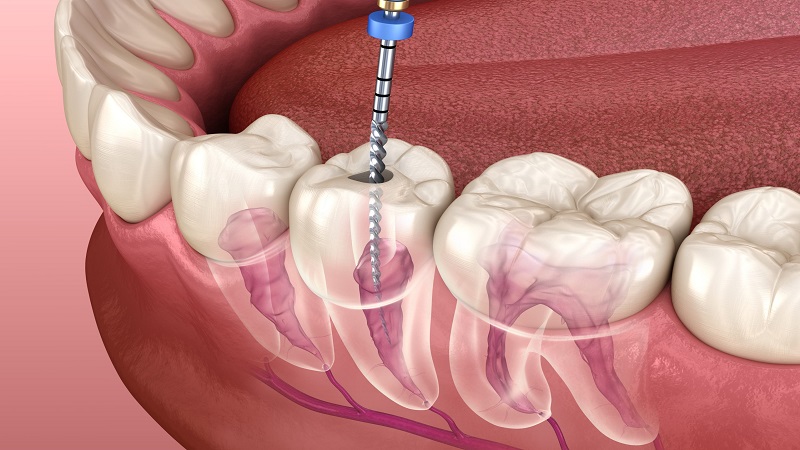 مزایا و معایب عصب کشی دندان | Le meilleur dentiste d'Ispahan - le meilleur chirurgien des gencives d'Ispahan - le meilleur dentiste cosmétique d'Ispahan | Dr Hossein Borjian