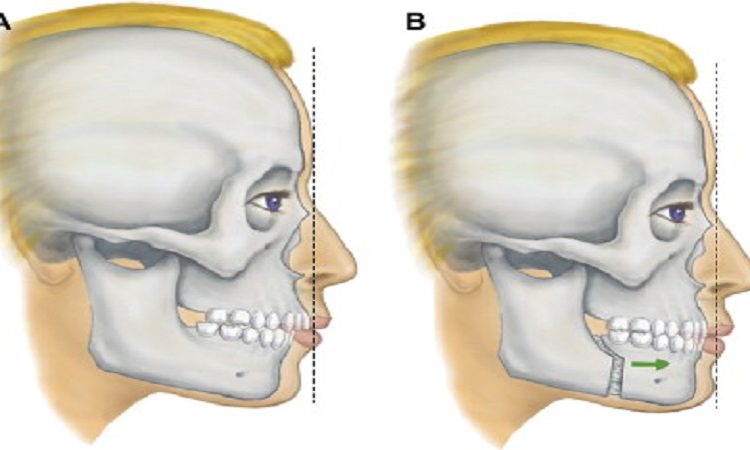 Traitement de la petite mandibule | Le meilleur dentiste d'Ispahan - le meilleur chirurgien des gencives d'Ispahan - le meilleur dentiste cosmétique d'Ispahan | Dr Hossein Borjian