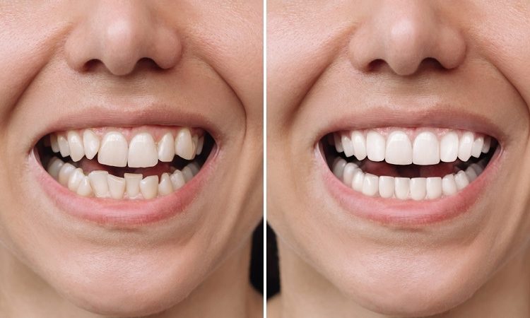 درمان درد دندان روکش شده | The best dentist in Isfahan - the best gum surgeon in Isfahan - the best cosmetic dentist in Isfahan | Dr. Hossein Borjian