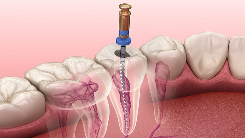 Root canal treatment and nerve extraction | The best dentist in Isfahan - the best gum surgeon in Isfahan - the best cosmetic dentist in Isfahan | Dr. Hossein Borjian