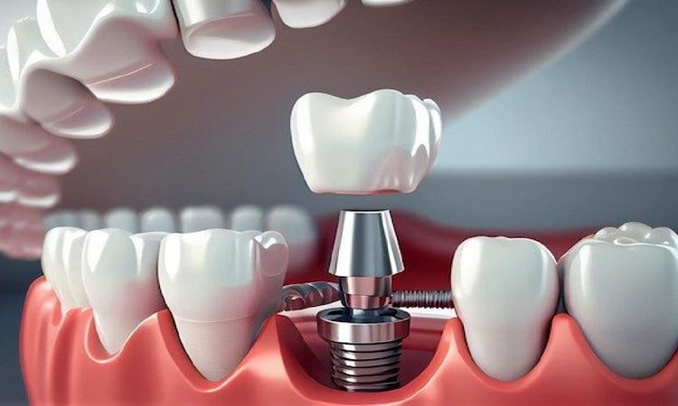 Implantation d'implants dentaires sans chirurgie | Le meilleur dentiste d'Ispahan - le meilleur chirurgien des gencives d'Ispahan - le meilleur dentiste cosmétique d'Ispahan | Dr Hossein Borjian