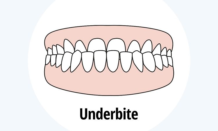 جلو بودن دندان و فک پایین (آندربایت) | بهترین دندانپزشک اصفهان-بهترین جراح لثه اصفهان-بهترین دندانپزشک زیبایی اصفهان | دکتر حسین برجیان