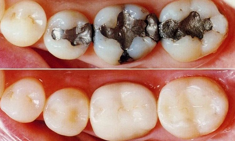 Remplissage des dents avec du composite | Le meilleur dentiste d'Ispahan - le meilleur chirurgien des gencives d'Ispahan - le meilleur dentiste cosmétique d'Ispahan | Dr Hossein Borjian