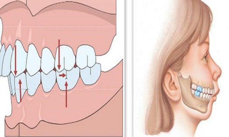 Étapes de détection de la supraclusion | Le meilleur dentiste d'Ispahan - le meilleur chirurgien des gencives d'Ispahan - le meilleur dentiste cosmétique d'Ispahan | Dr Hossein Borjian