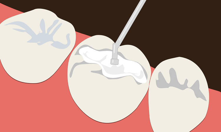 ریختن دیواره دندان پر شده | Le meilleur dentiste d'Ispahan - le meilleur chirurgien des gencives d'Ispahan - le meilleur dentiste cosmétique d'Ispahan | Dr Hossein Borjian