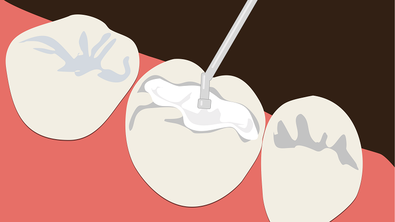 ریختن دیواره دندان پر شده | Le meilleur dentiste d'Ispahan - le meilleur chirurgien des gencives d'Ispahan - le meilleur dentiste cosmétique d'Ispahan | Dr Hossein Borjian