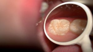 دندان کرسی در کودکان | Le meilleur dentiste d'Ispahan - le meilleur chirurgien des gencives d'Ispahan - le meilleur dentiste cosmétique d'Ispahan | Dr Hossein Borjian