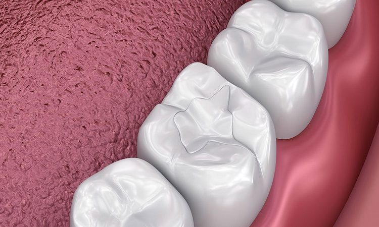 پرکردن دندان با کامپوزیت | The best dentist in Isfahan - the best gum surgeon in Isfahan - the best cosmetic dentist in Isfahan | Dr. Hossein Borjian