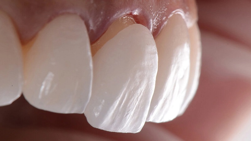 Douleur des composites dentaires | Le meilleur dentiste d'Ispahan - le meilleur chirurgien des gencives d'Ispahan - le meilleur dentiste cosmétique d'Ispahan | Dr Hossein Borjian 