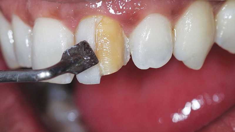 Douleur des composites dentaires | Le meilleur dentiste d'Ispahan - le meilleur chirurgien des gencives d'Ispahan - le meilleur dentiste cosmétique d'Ispahan | Dr Hossein Borjian
